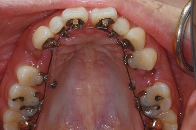 大人が歯の矯正治療を行うメリット